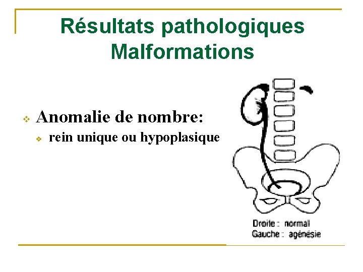 Résultats pathologiques Malformations v Anomalie de nombre: v rein unique ou hypoplasique 