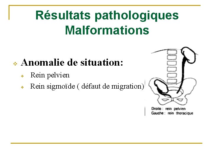 Résultats pathologiques Malformations v Anomalie de situation: v v Rein pelvien Rein sigmoïde (