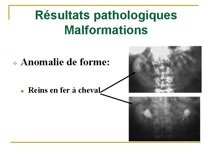 Résultats pathologiques Malformations v Anomalie de forme: v Reins en fer à cheval 