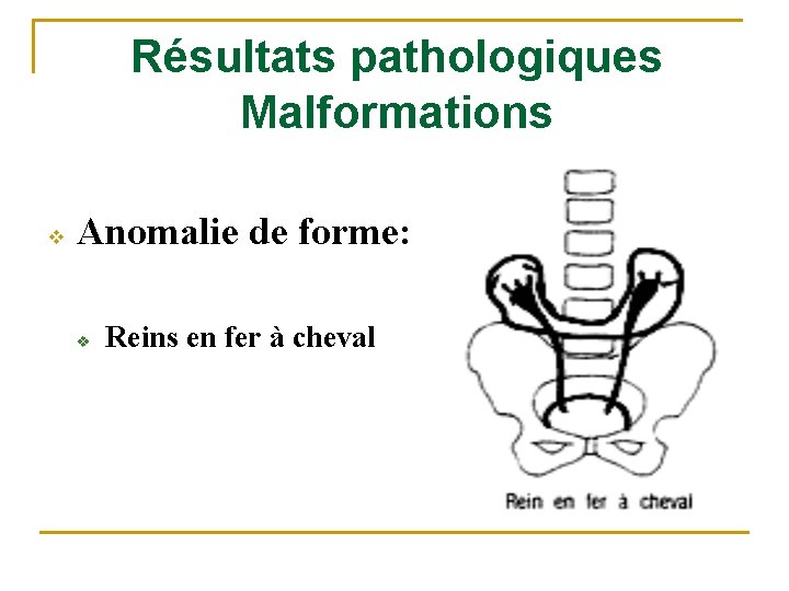 Résultats pathologiques Malformations v Anomalie de forme: v Reins en fer à cheval 