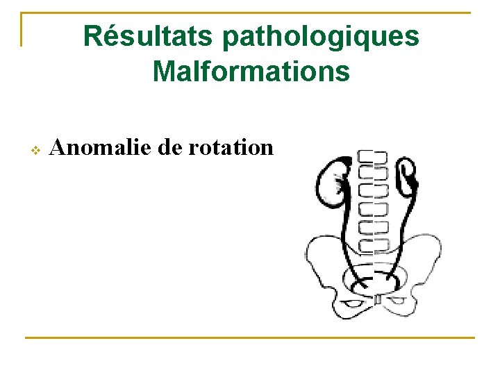 Résultats pathologiques Malformations v Anomalie de rotation 