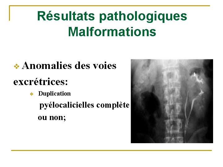 Résultats pathologiques Malformations v Anomalies des voies excrétrices: v Duplication pyélocalicielles complète ou non;