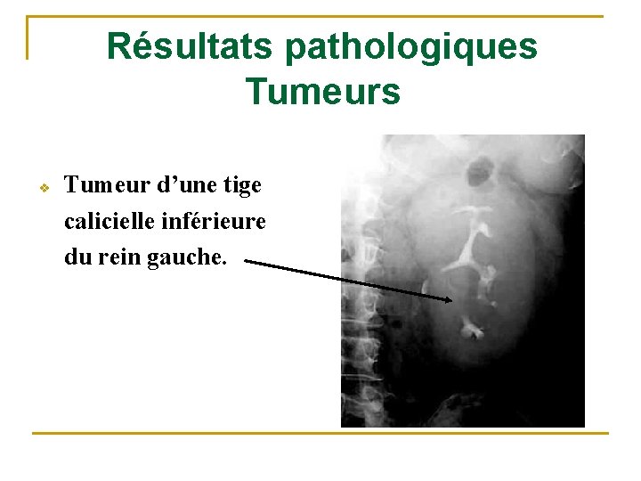 Résultats pathologiques Tumeurs v Tumeur d’une tige calicielle inférieure du rein gauche. 