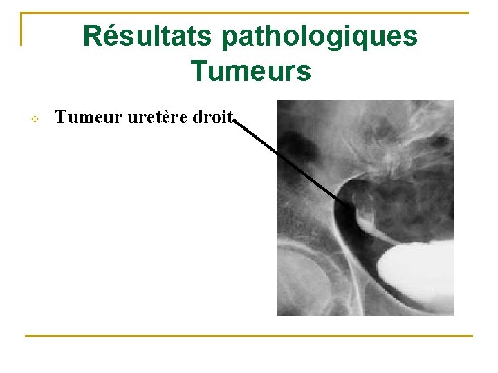 Résultats pathologiques Tumeurs v Tumeur uretère droit 