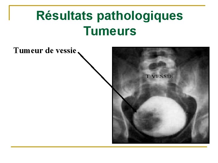 Résultats pathologiques Tumeur de vessie 