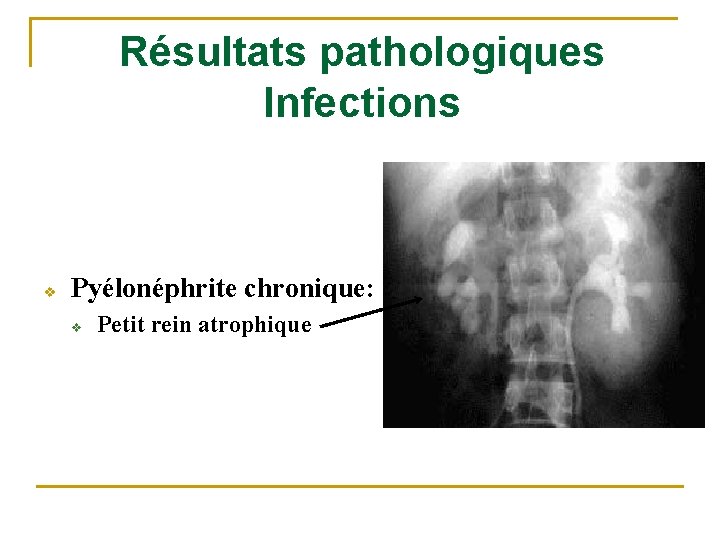 Résultats pathologiques Infections v Pyélonéphrite chronique: v Petit rein atrophique 