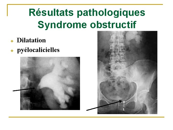 Résultats pathologiques Syndrome obstructif v v Dilatation pyélocalicielles 