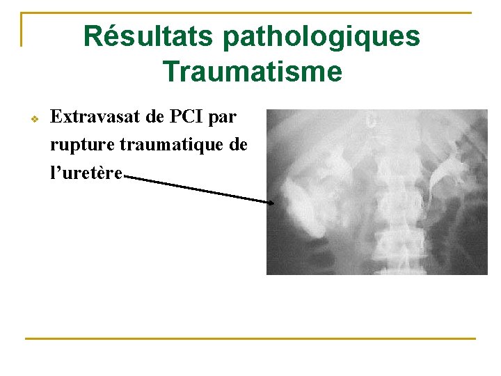 Résultats pathologiques Traumatisme v Extravasat de PCI par rupture traumatique de l’uretère 