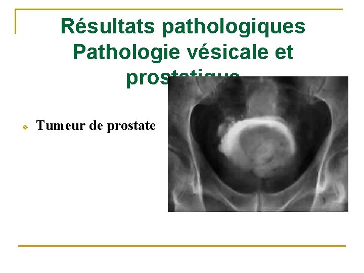 Résultats pathologiques Pathologie vésicale et prostatique v Tumeur de prostate 