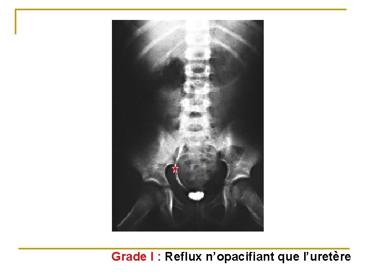 Grade I : Reflux n’opacifiant que l’uretère 