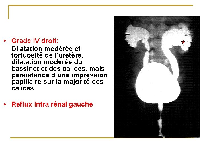  • Grade IV droit: Dilatation modérée et tortuosité de l’uretère, dilatation modérée du