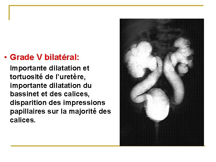  • Grade V bilatéral: Importante dilatation et tortuosité de l’uretère, importante dilatation du