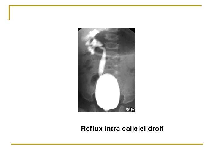 Reflux intra caliciel droit 