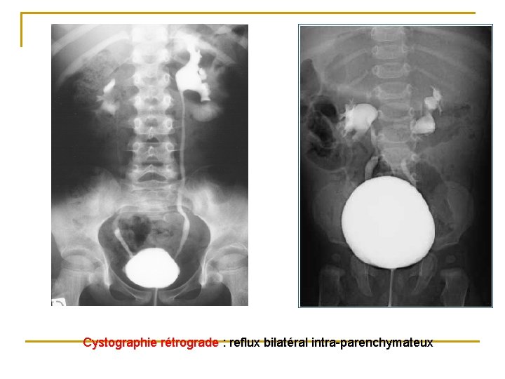 Cystographie rétrograde : reflux bilatéral intra-parenchymateux 