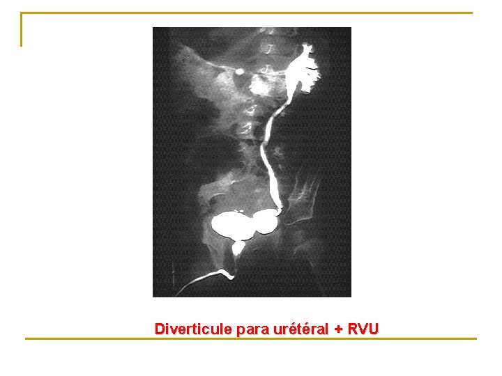 Diverticule para urétéral + RVU 