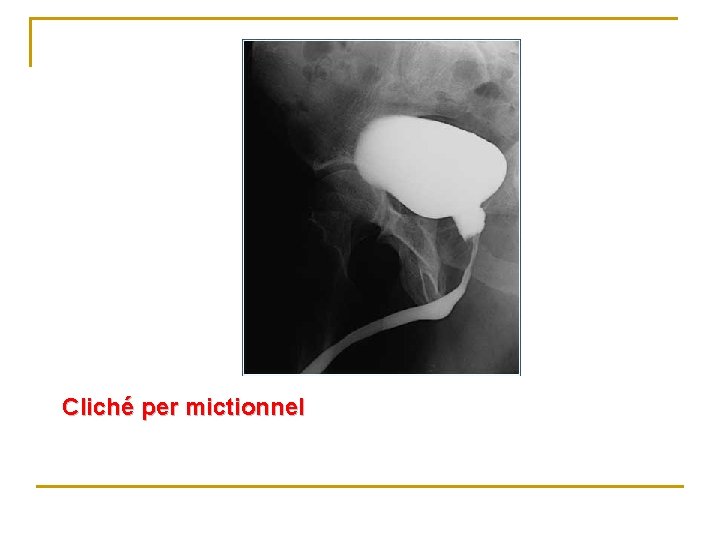 Cliché per mictionnel 