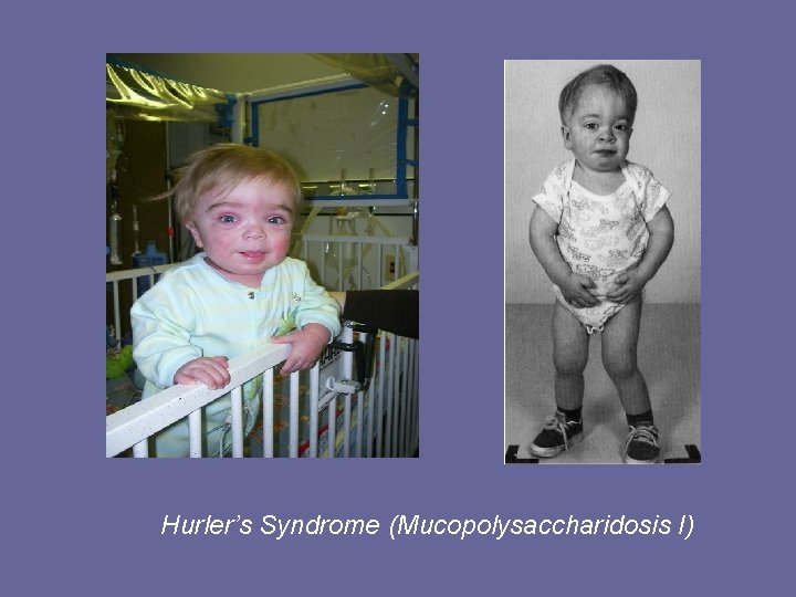 Hurler’s Syndrome (Mucopolysaccharidosis I) 