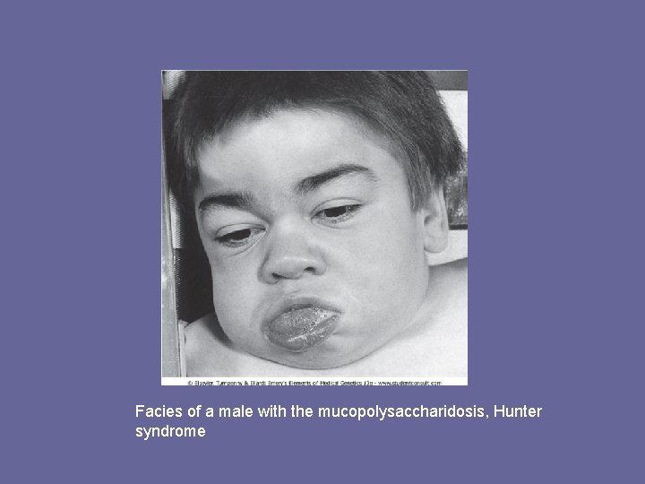 Facies of a male with the mucopolysaccharidosis, Hunter syndrome 