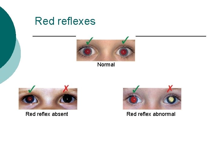 Red reflexes Normal Red reflex absent Red reflex abnormal 