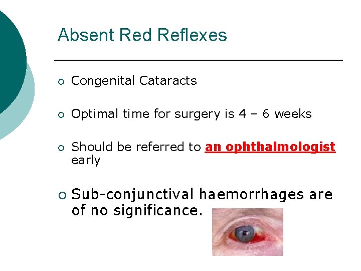 Absent Red Reflexes ¡ Congenital Cataracts ¡ Optimal time for surgery is 4 –