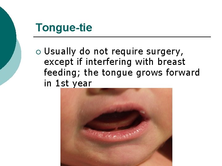 Tongue-tie ¡ Usually do not require surgery, except if interfering with breast feeding; the