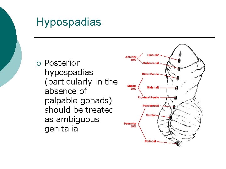 Hypospadias ¡ Posterior hypospadias (particularly in the absence of palpable gonads) should be treated