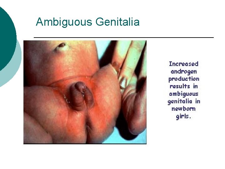 Ambiguous Genitalia 