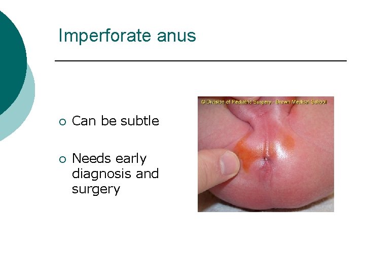 Imperforate anus ¡ ¡ Can be subtle Needs early diagnosis and surgery 