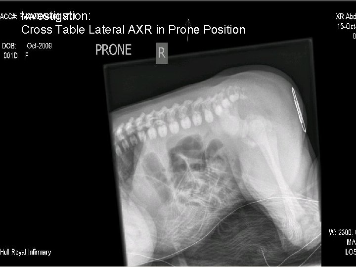 Investigation: Cross Table Lateral AXR in Prone Position 