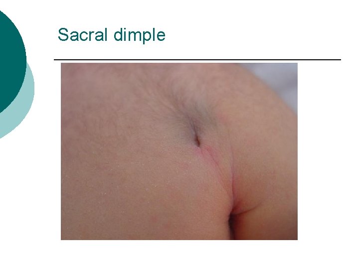 Sacral dimple 