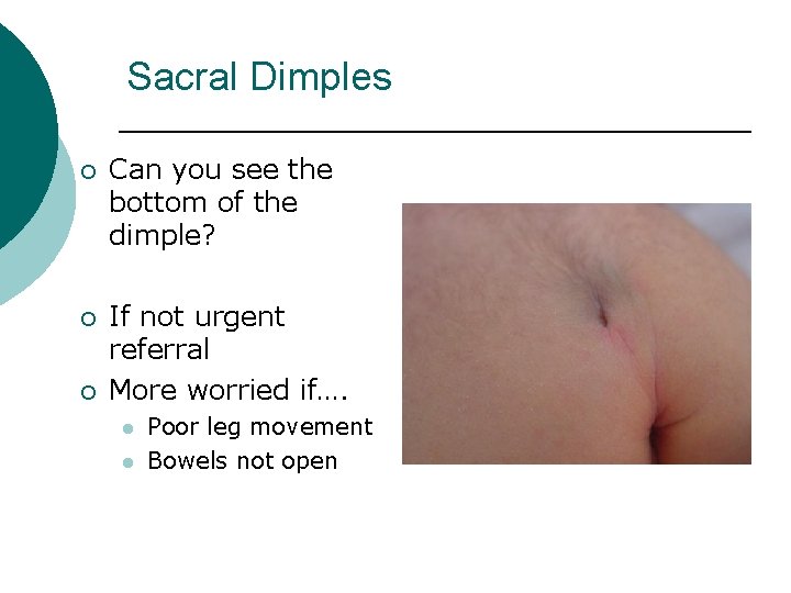 Sacral Dimples ¡ ¡ ¡ Can you see the bottom of the dimple? If