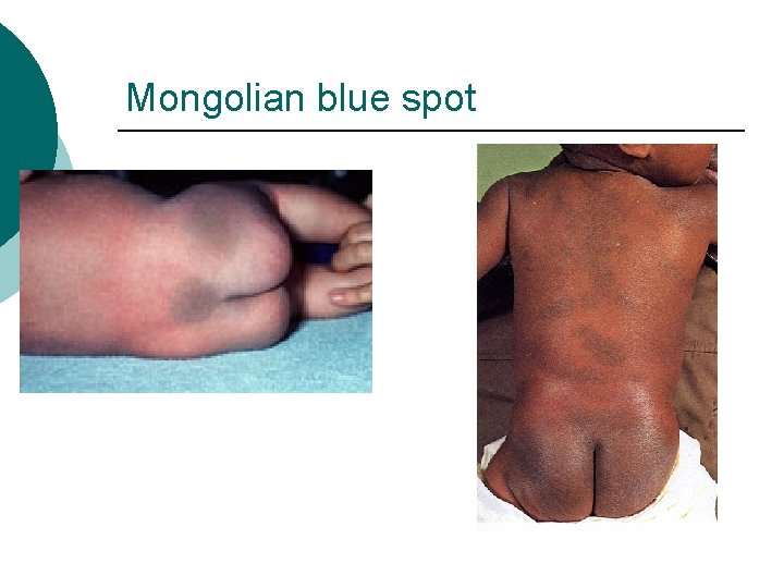 Mongolian blue spot 