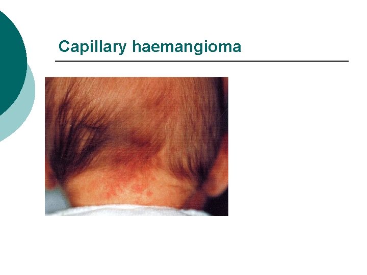 Capillary haemangioma 