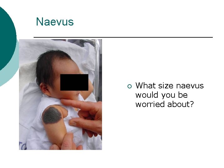 Naevus ¡ What size naevus would you be worried about? 