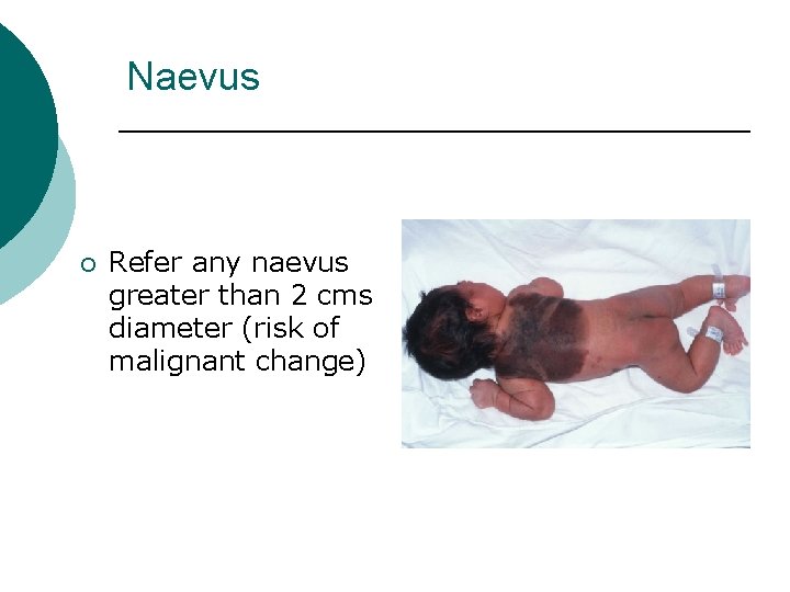 Naevus ¡ Refer any naevus greater than 2 cms diameter (risk of malignant change)