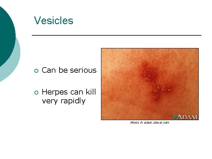 Vesicles ¡ ¡ Can be serious Herpes can kill very rapidly 
