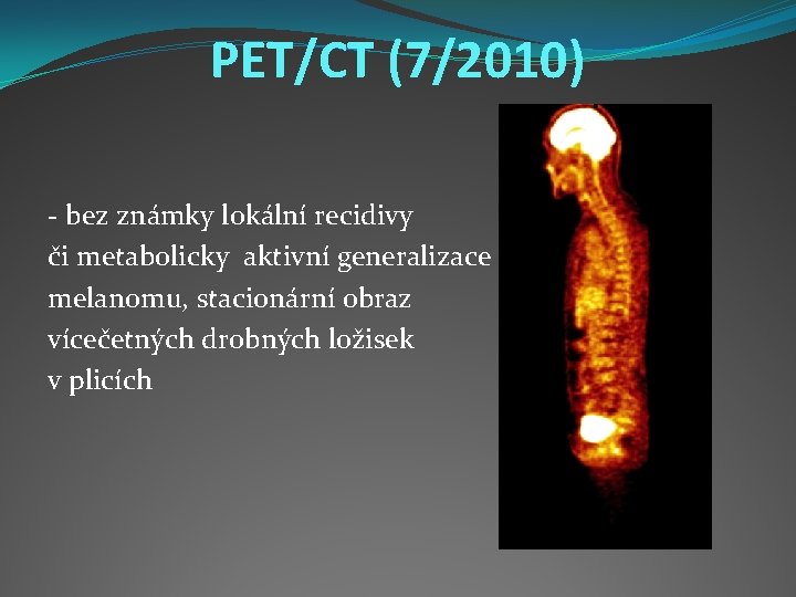 PET/CT (7/2010) - bez známky lokální recidivy či metabolicky aktivní generalizace melanomu, stacionární obraz