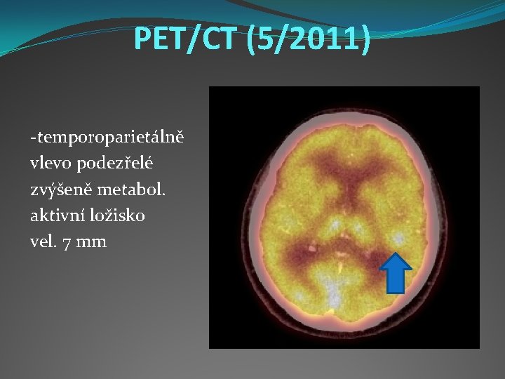 PET/CT (5/2011) -temporoparietálně vlevo podezřelé zvýšeně metabol. aktivní ložisko vel. 7 mm 