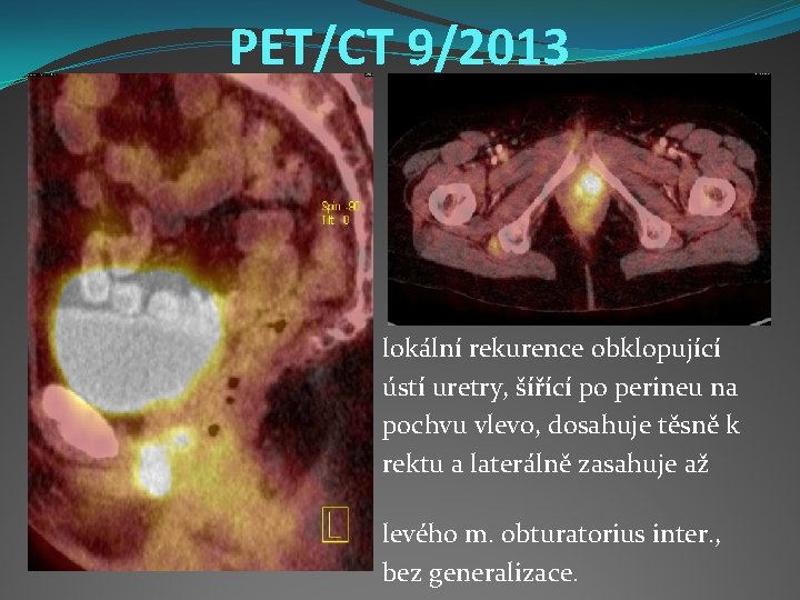 PET/CT 9/2013 do lokální rekurence obklopující ústí uretry, šířící po perineu na pochvu vlevo,