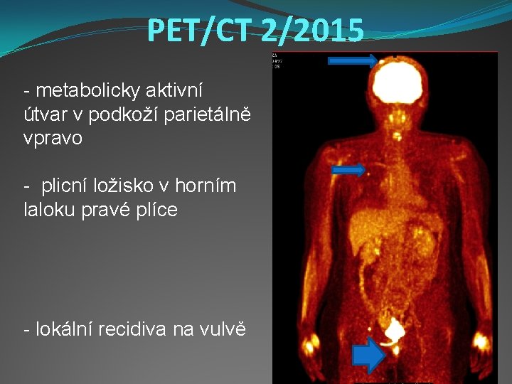 PET/CT 2/2015 - metabolicky aktivní útvar v podkoží parietálně vpravo - plicní ložisko v