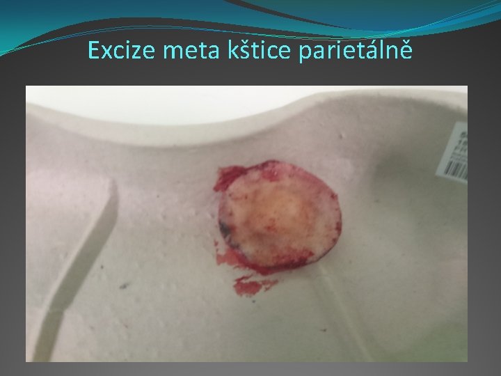 Excize meta kštice parietálně 