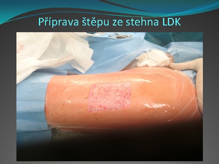 Příprava štěpu ze stehna LDK 