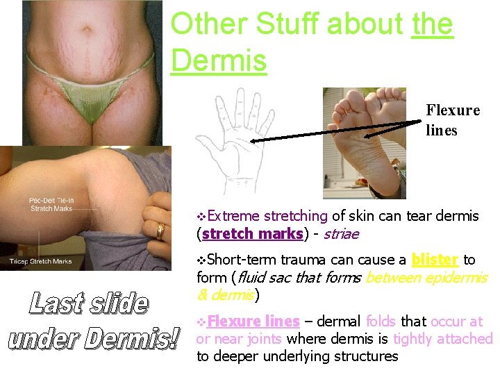 Other Stuff about the Dermis Flexure lines v. Extreme stretching of skin can tear