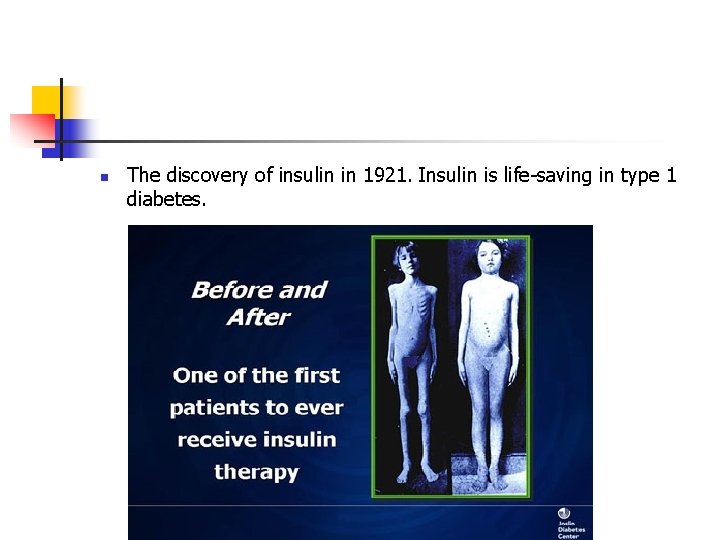n The discovery of insulin in 1921. Insulin is life-saving in type 1 diabetes.