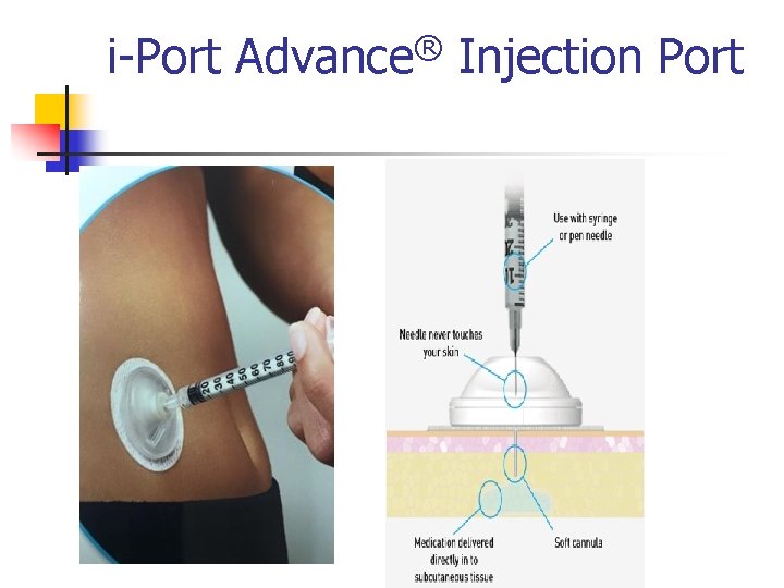 i-Port Advance® Injection Port 