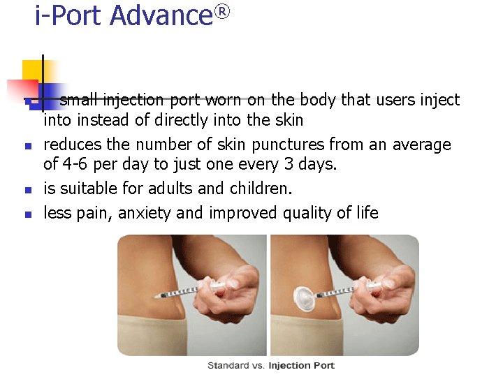 i-Port Advance® n n small injection port worn on the body that users inject