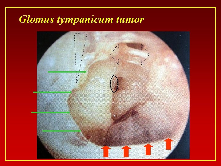 Glomus tympanicum tumor 