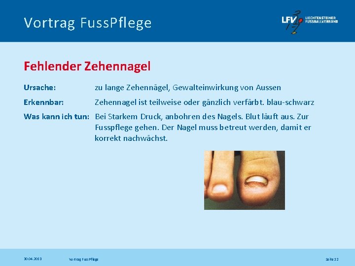 Vortrag Fuss. Pflege Fehlender Zehennagel Ursache: zu lange Zehennägel, Gewalteinwirkung von Aussen Erkennbar: Zehennagel