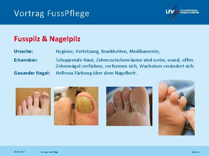 Vortrag Fuss. Pflege Fusspilz & Nagelpilz Ursache: Hygiene, Verletzung, Krankheiten, Medikamente, Erkennbar: Schuppende Haut,