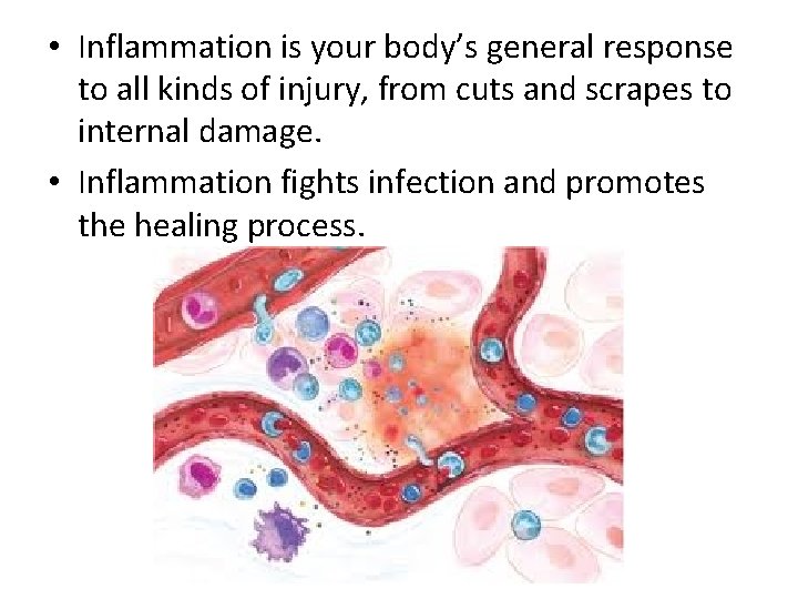  • Inflammation is your body’s general response to all kinds of injury, from